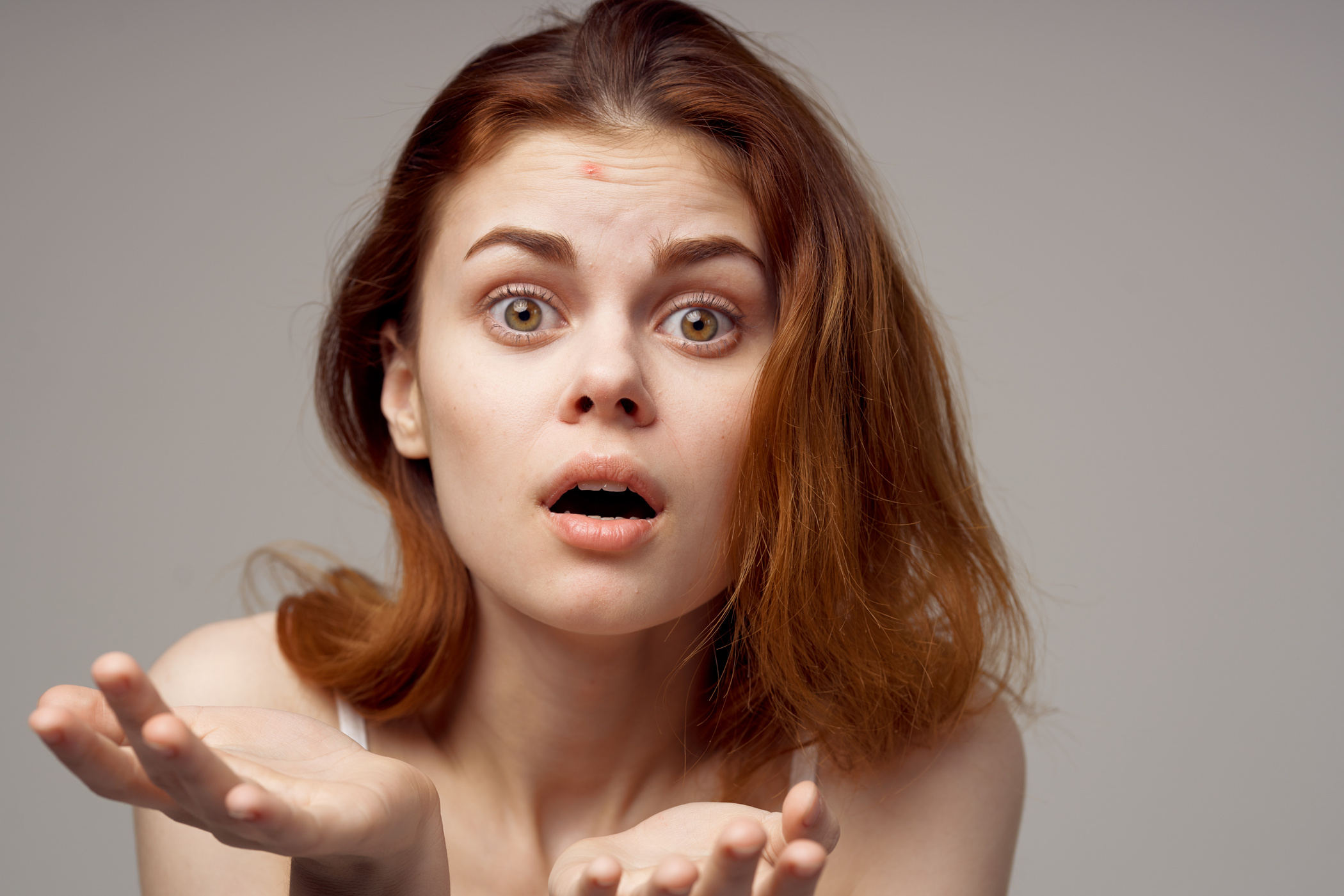 Surprised Woman with Acne on Her Face Health Problems Acne